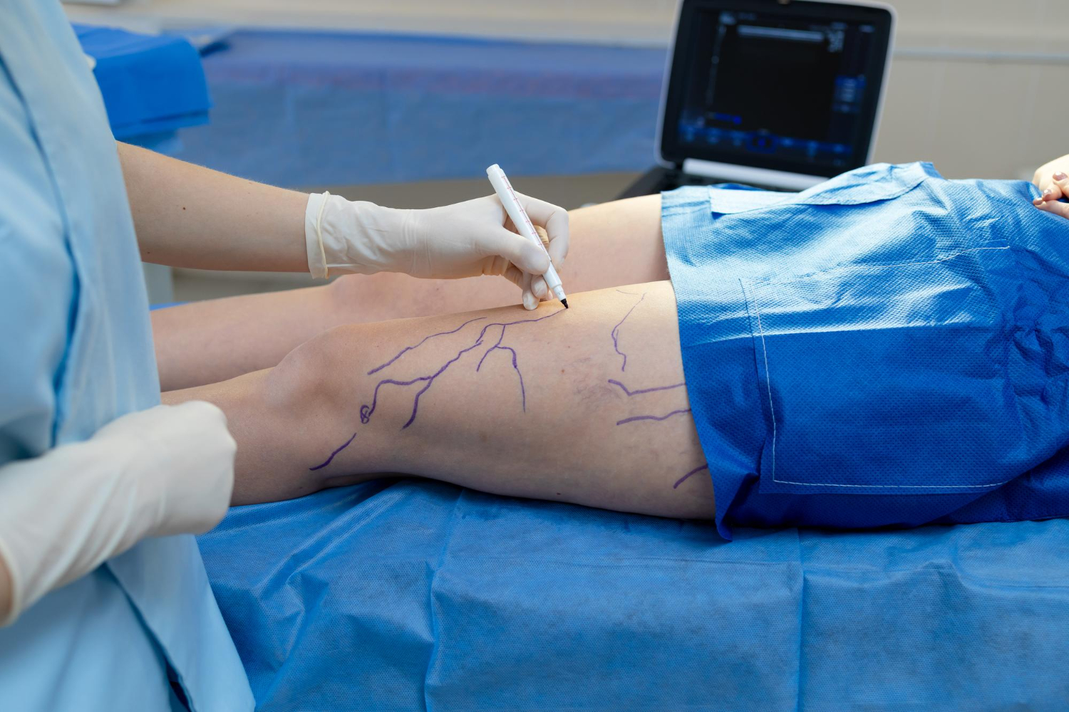 What Happens During Leg Vascular Surgery Step by Step