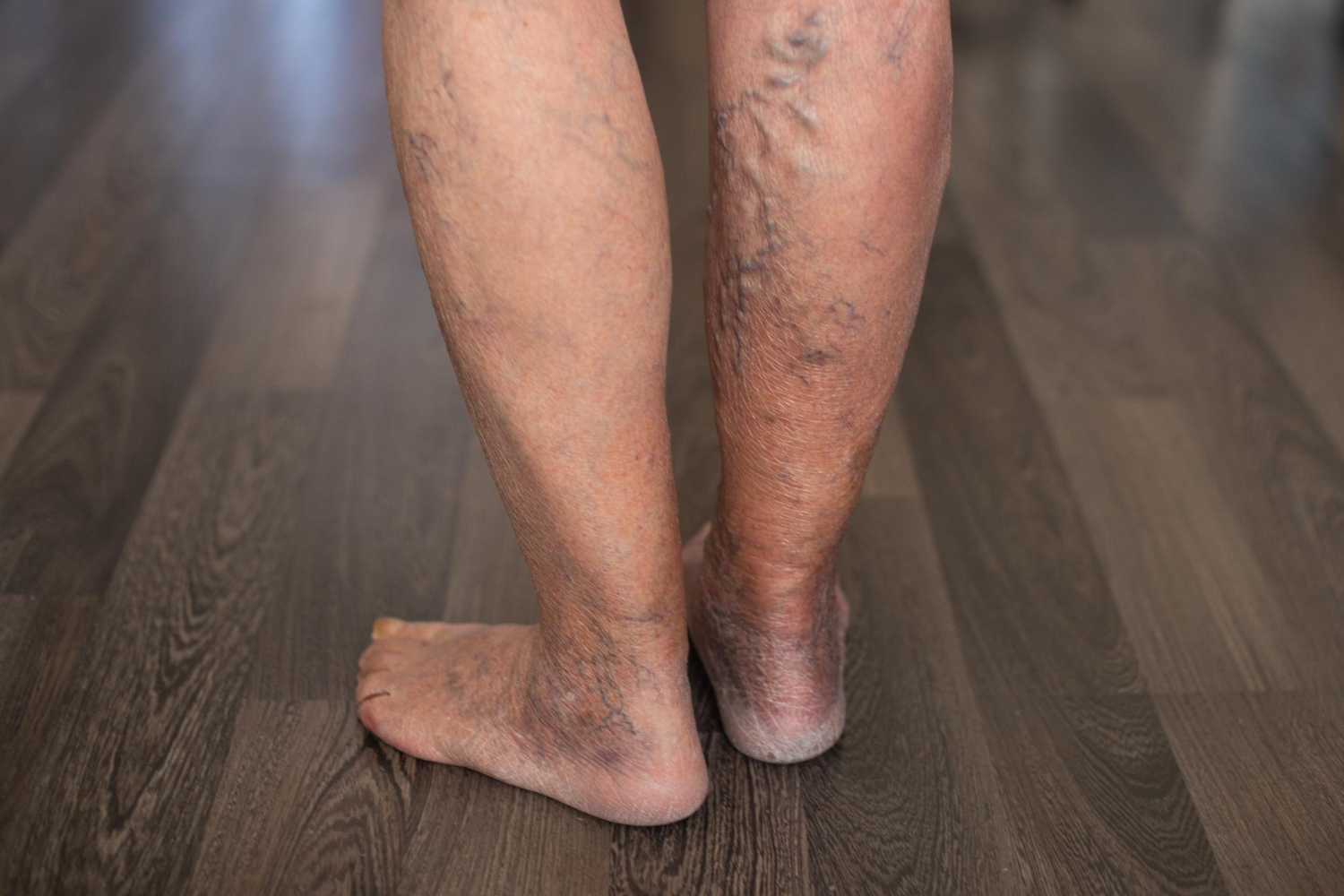Venous Insufficiency Treatment That Does More Than Just Help Legs