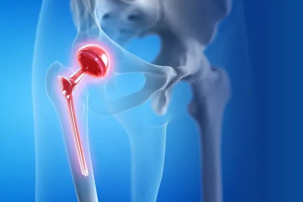 Hip Replacement