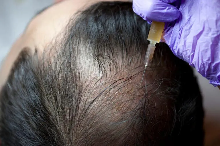 Hair loss treatments lake havasu