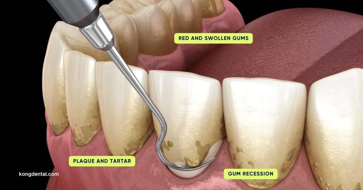 Periodontal Disease: Symptoms, Causes & Treatment