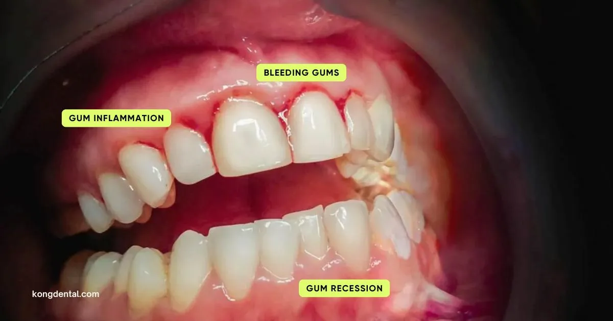 5 Ways Gum Disease Can Affect Your Health