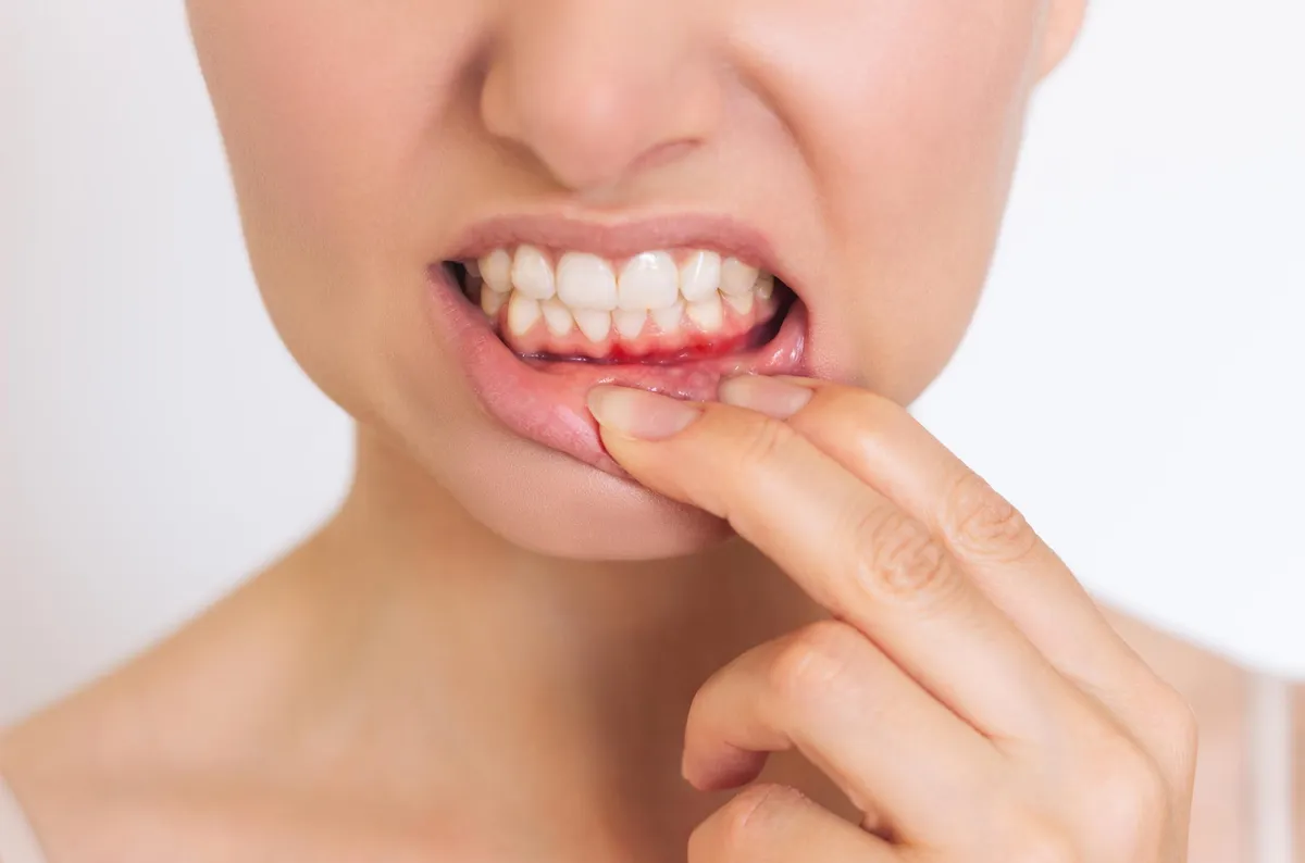 5 Early Warning Signs of Gum Disease