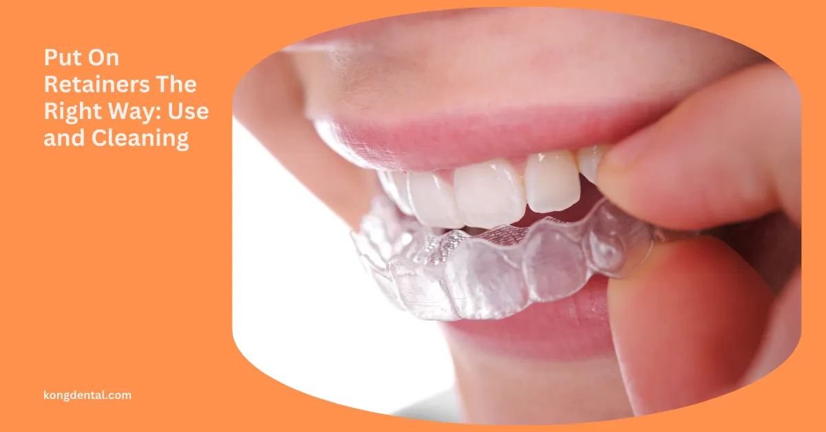 How to Wear and Clean Your Retainers