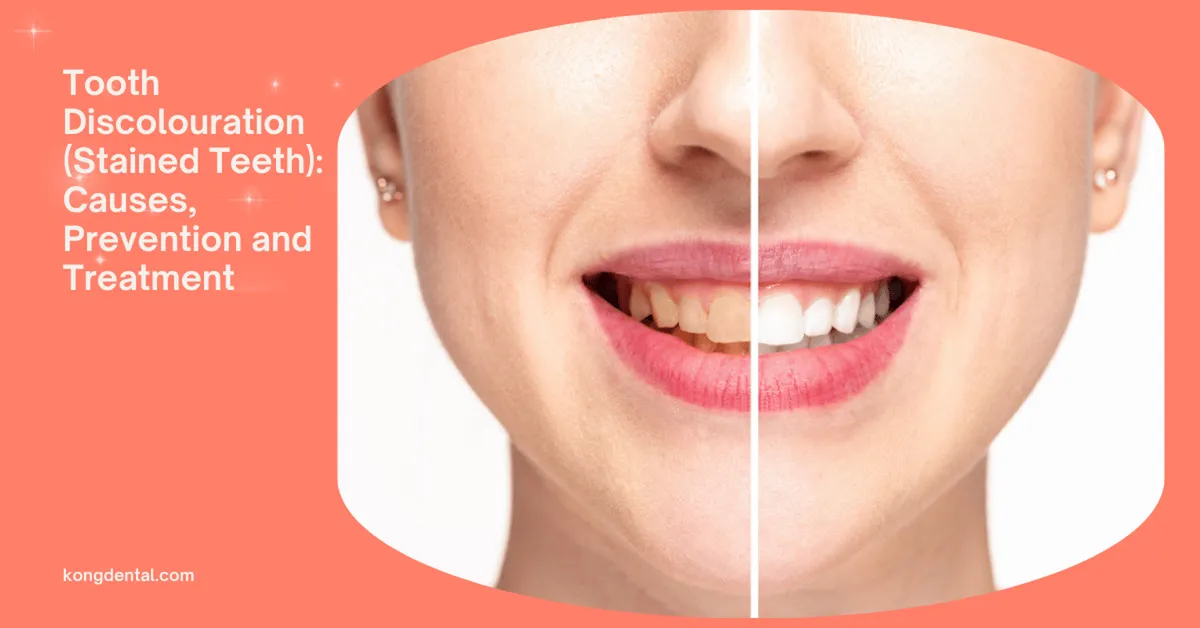 Tooth Discolouration (Stained Teeth): Causes, Prevention and Treatment