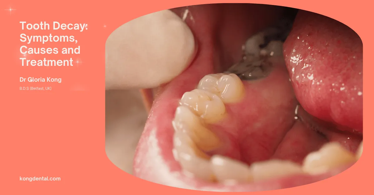 Tooth Decay: Symptoms, Causes and Treatment