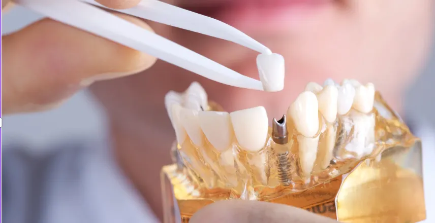 Dental Implants in Singapore: What are Dental Implants?