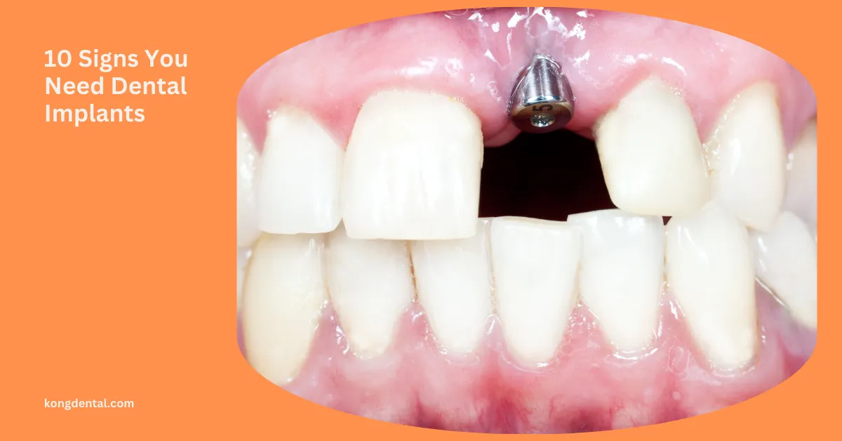 10 Signs You May Need Dental Implants