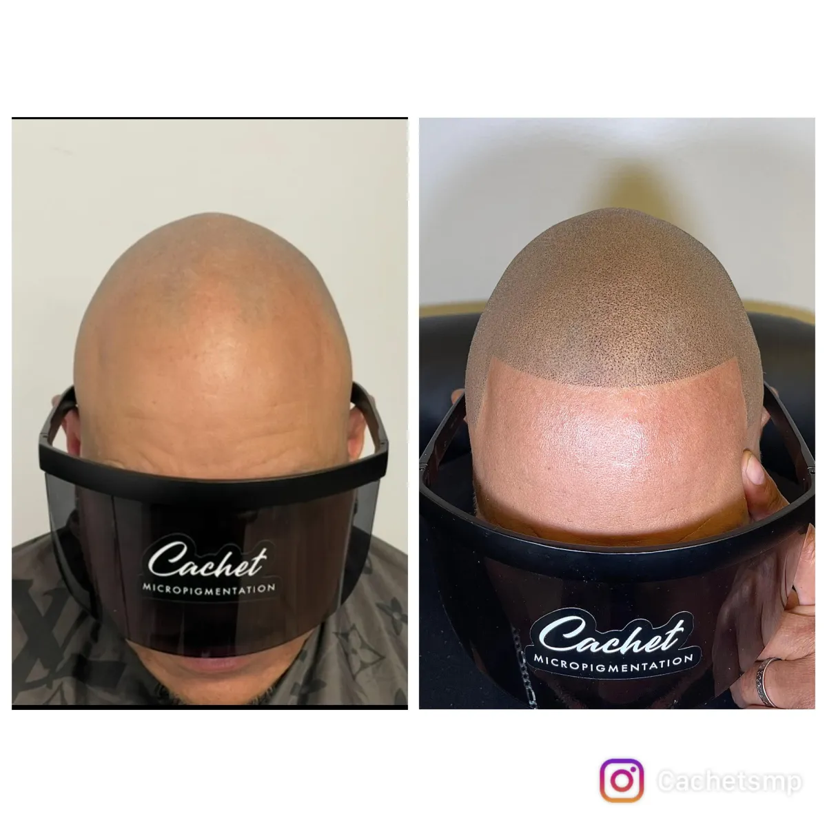 hair loss