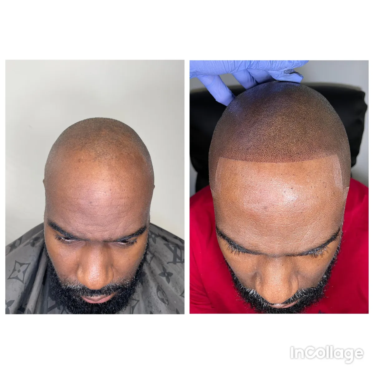 natural hair line