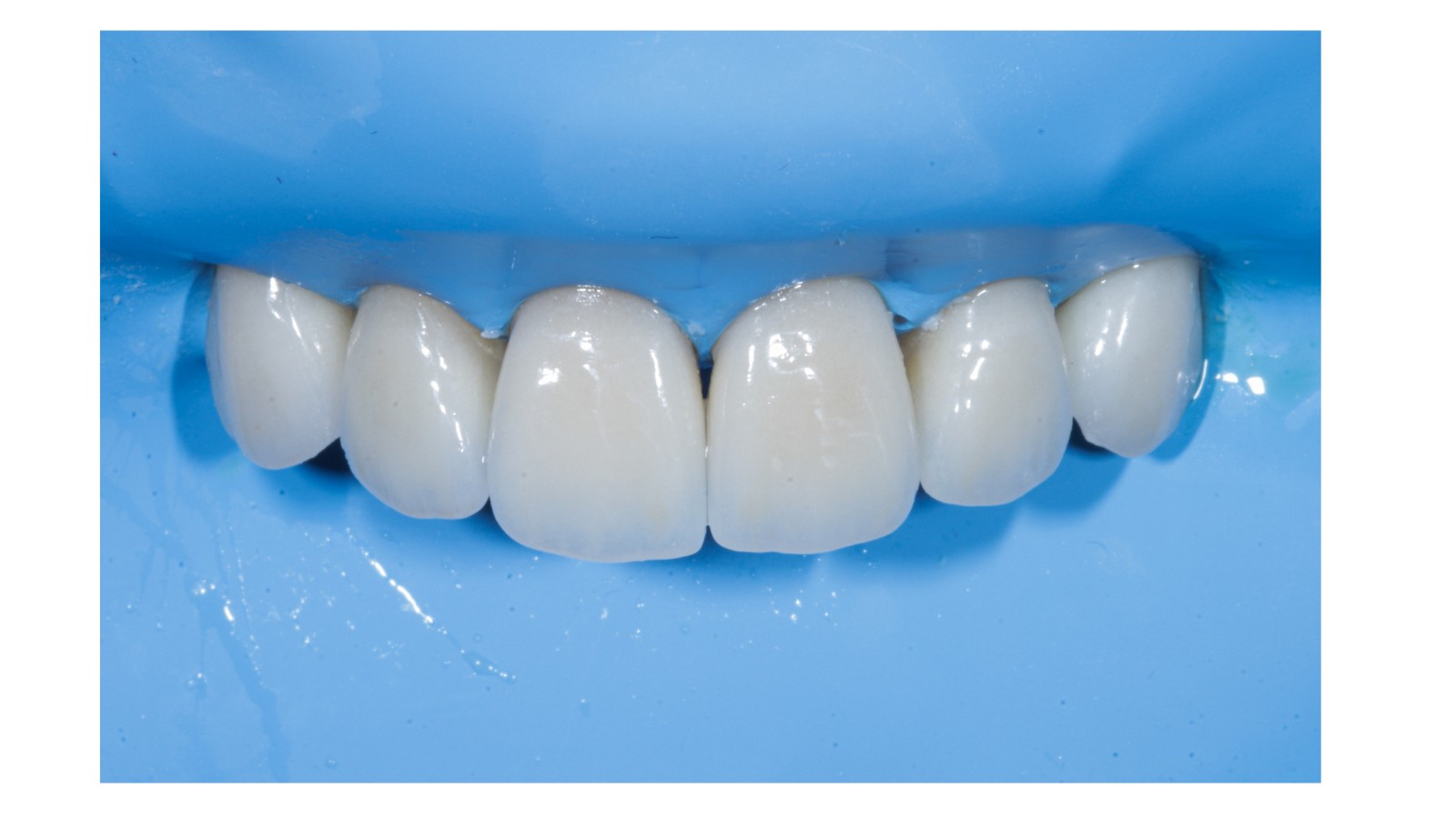 Dental bonding used to repair chipped tooth at North York dental clinic