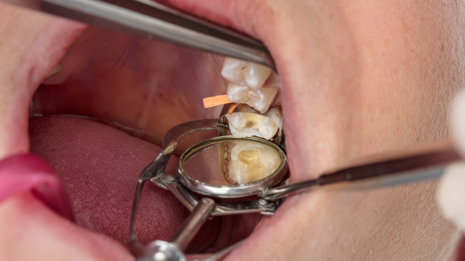dentist examining tooth cavity before dental filling treatment in North York Ontario