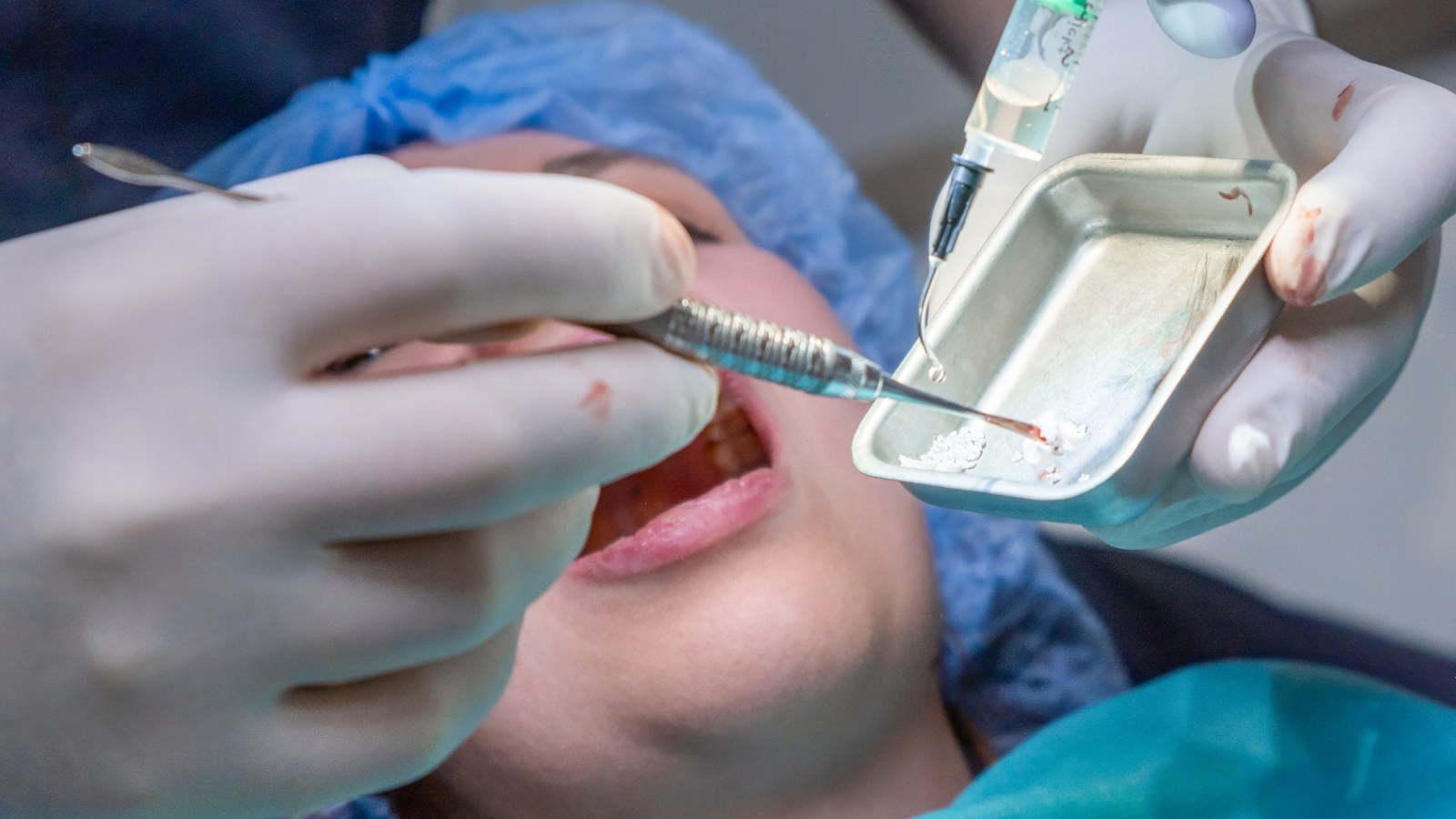 dentist placing a dental filling to treat a cavity in North York Ontario