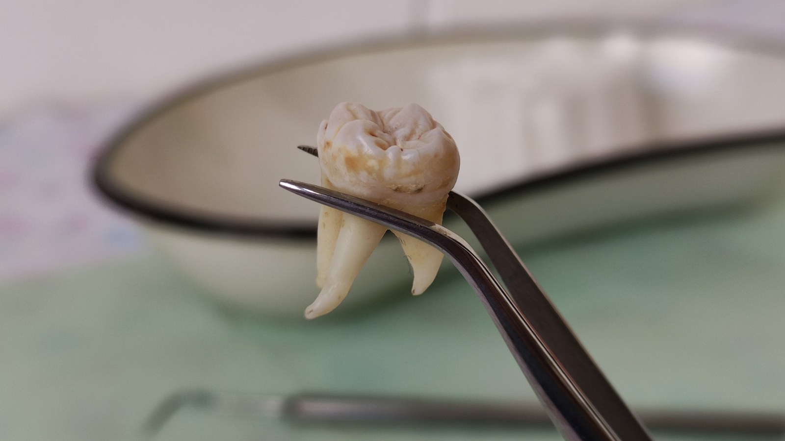 tooth extraction procedure result in North York Ontario