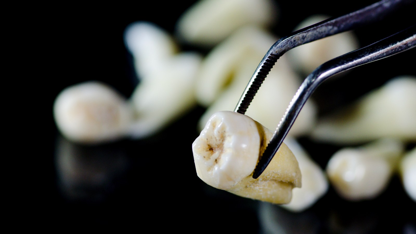 tooth extraction procedure result in North York Ontario