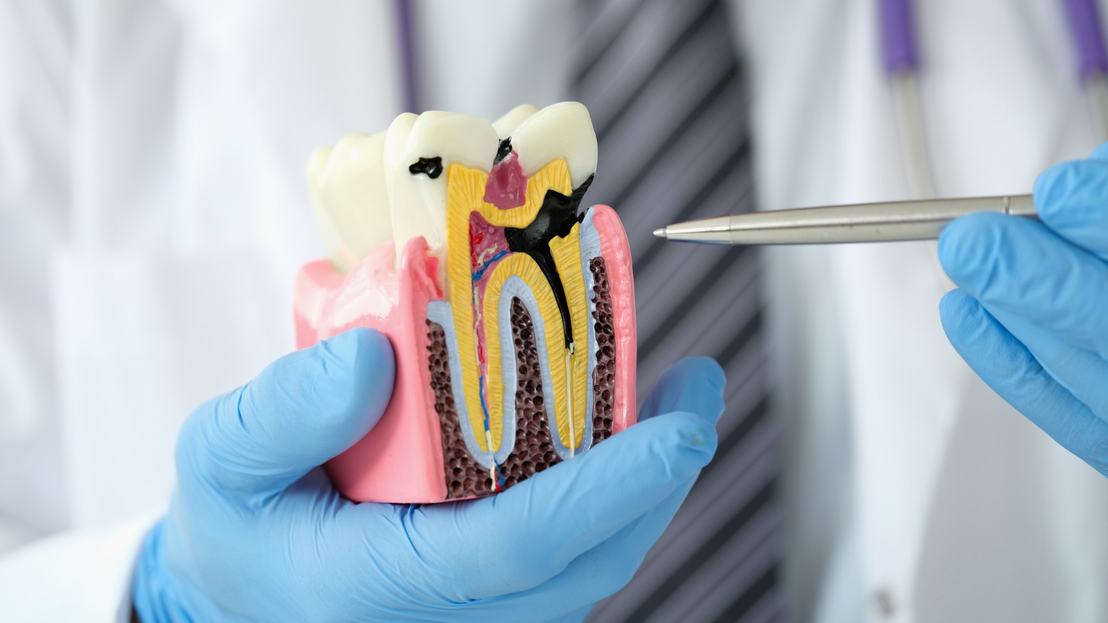 signs of tooth infection that may require root canal treatment