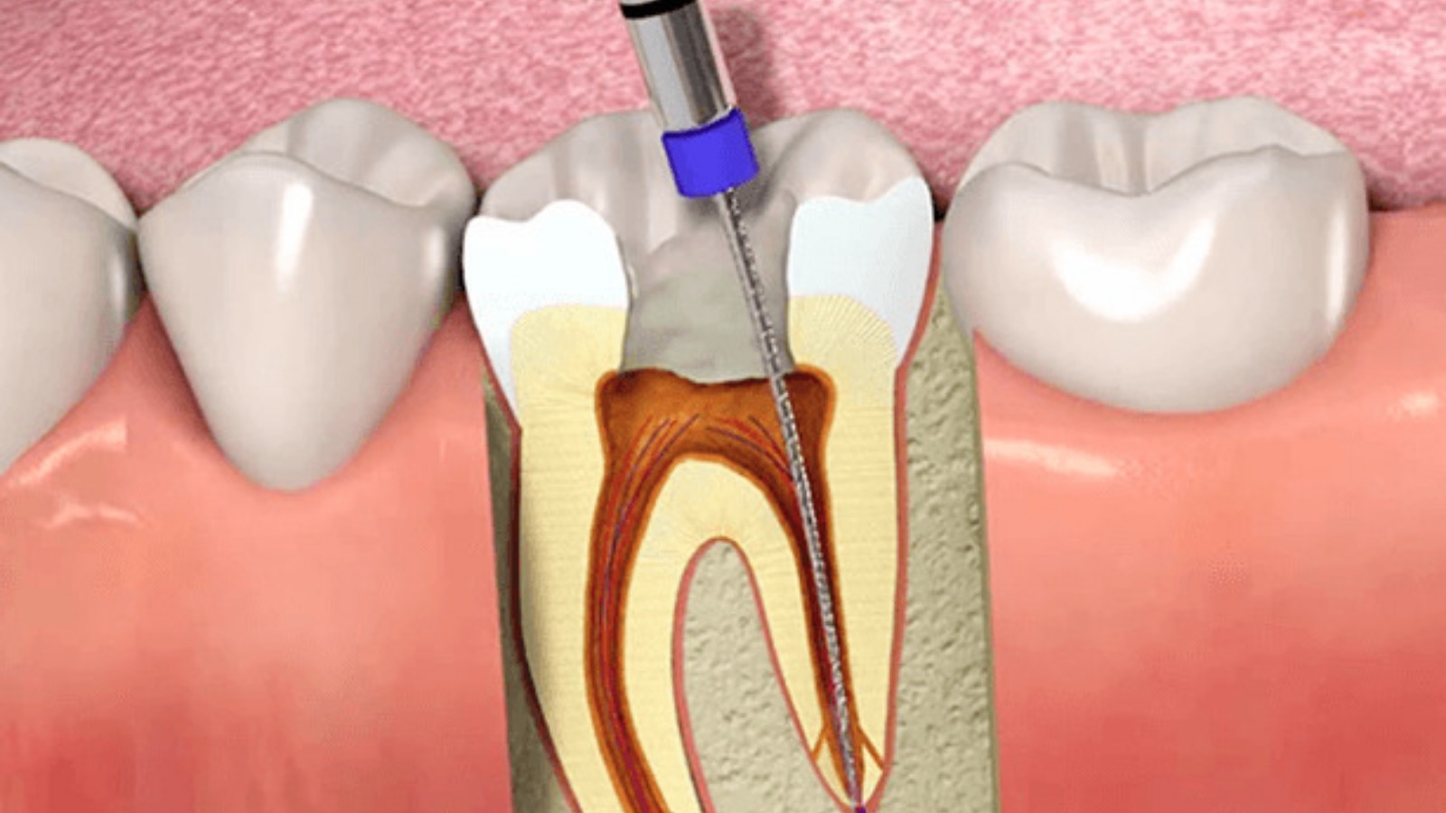 root canal treatment procedure in North York Ontario dental clinic