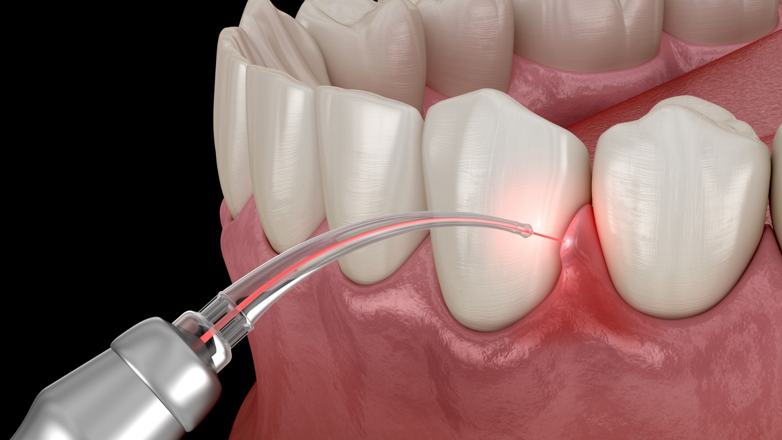 professional gum disease treatment removing plaque below gumline