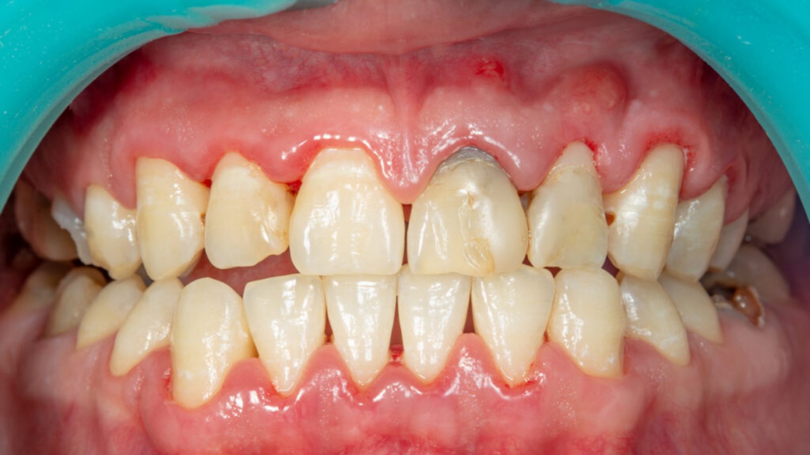 signs of gum disease including red swollen and bleeding gums