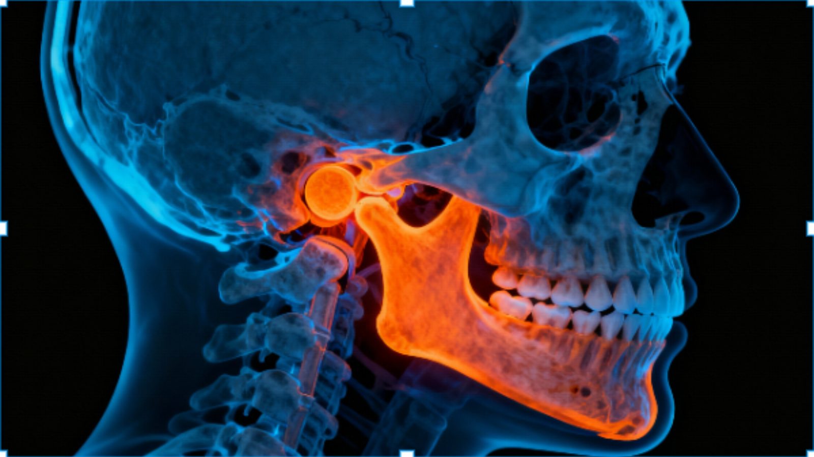 TMJ disorder jaw joint pain illustration showing temporomandibular joint