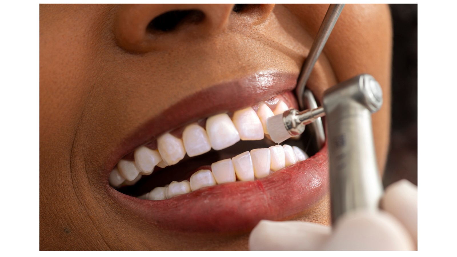 Dentist and patient smiling during professional dental cleaning at O’Connor Dental Care in North York Ontario