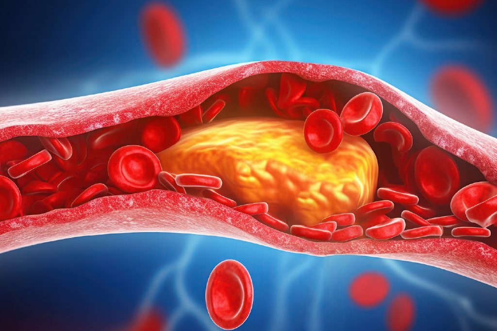 An illustration of blood cells and cholesterol in an artery