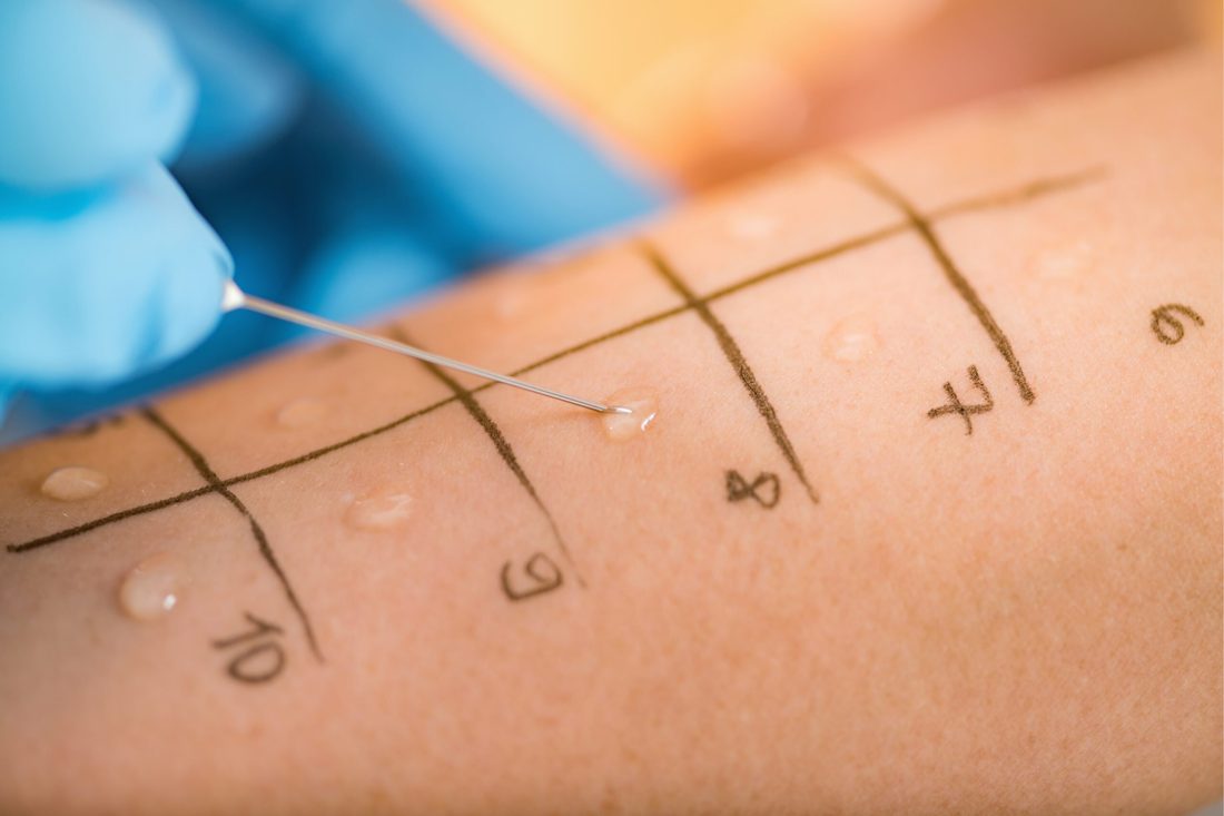 Allergy testing prick test on a patient's back
