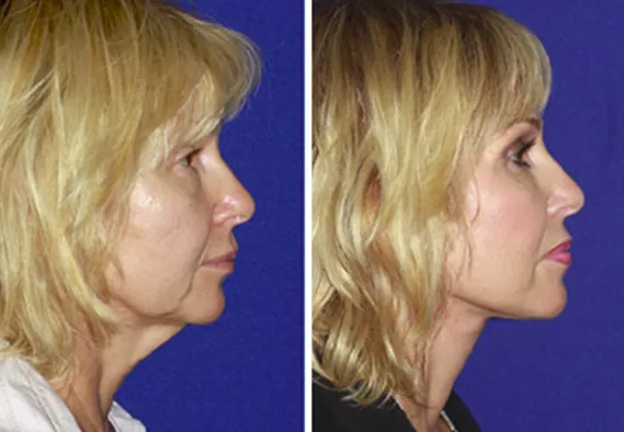 A black and white photo of a person on a skateboard