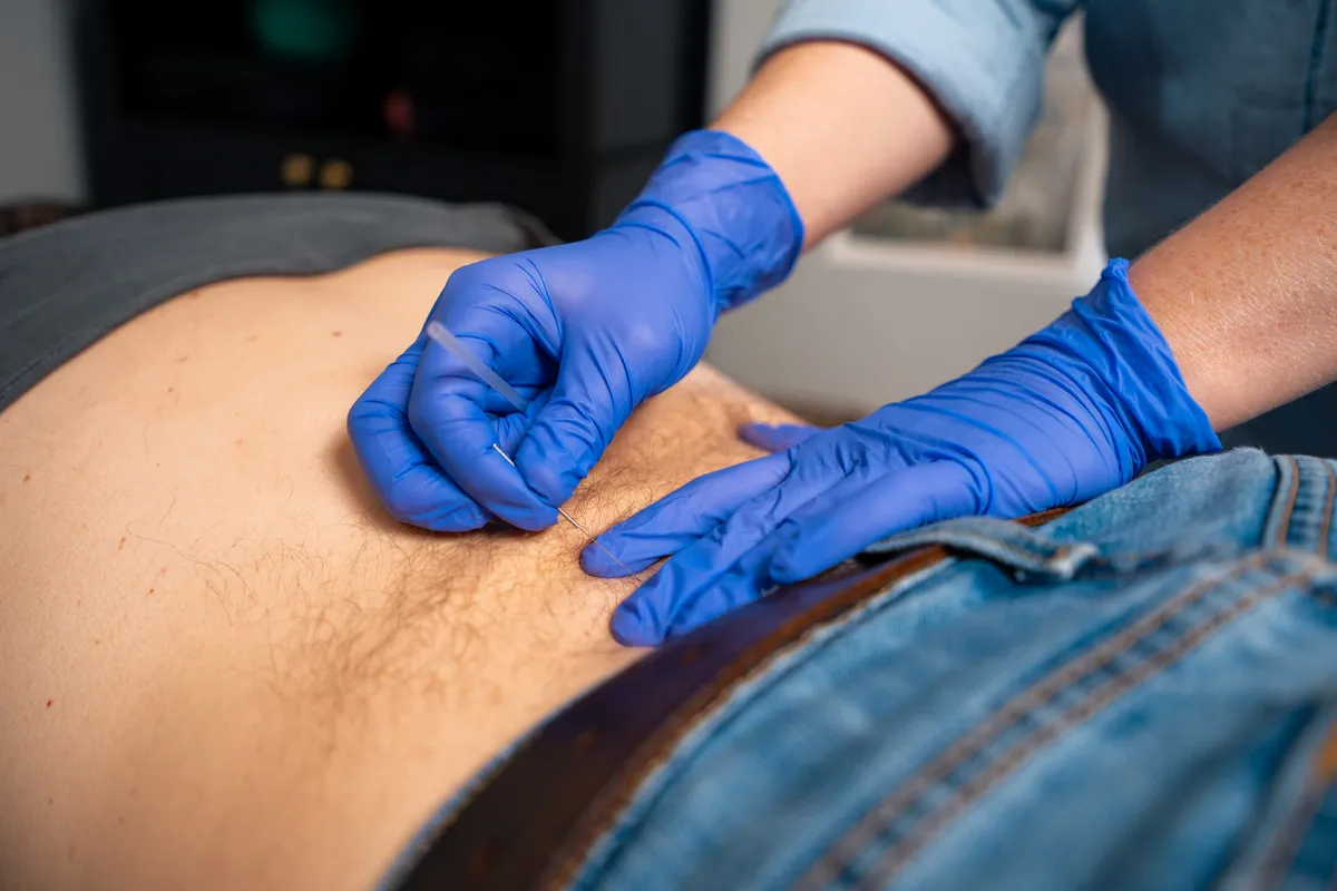 Dry Needling in Santa Rosa Beach FL