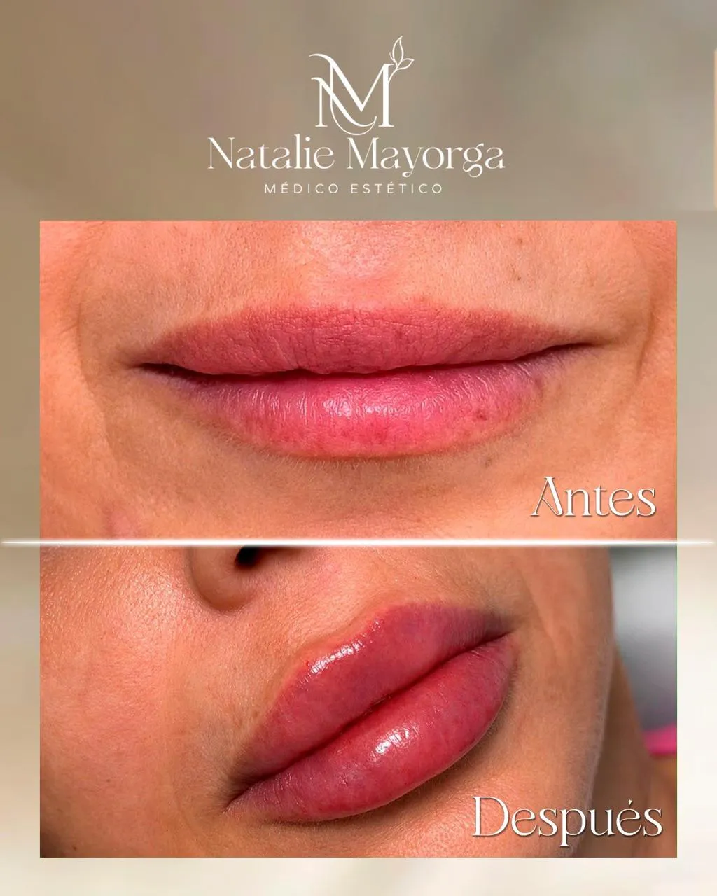 Resultado de paciente - Mamoplastia
