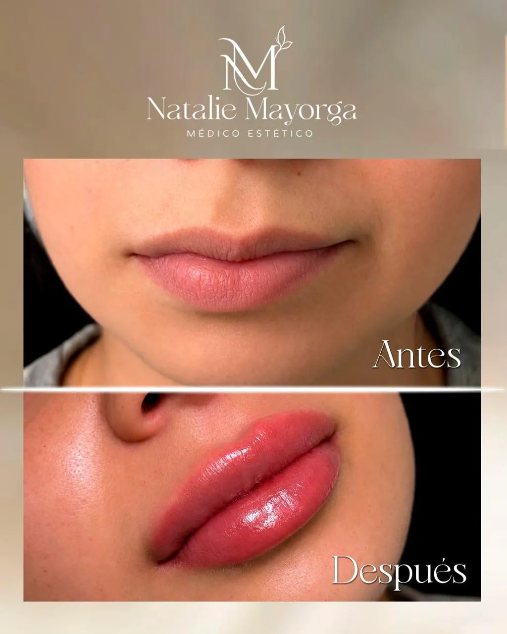 Resultado de paciente - Lifting Facial