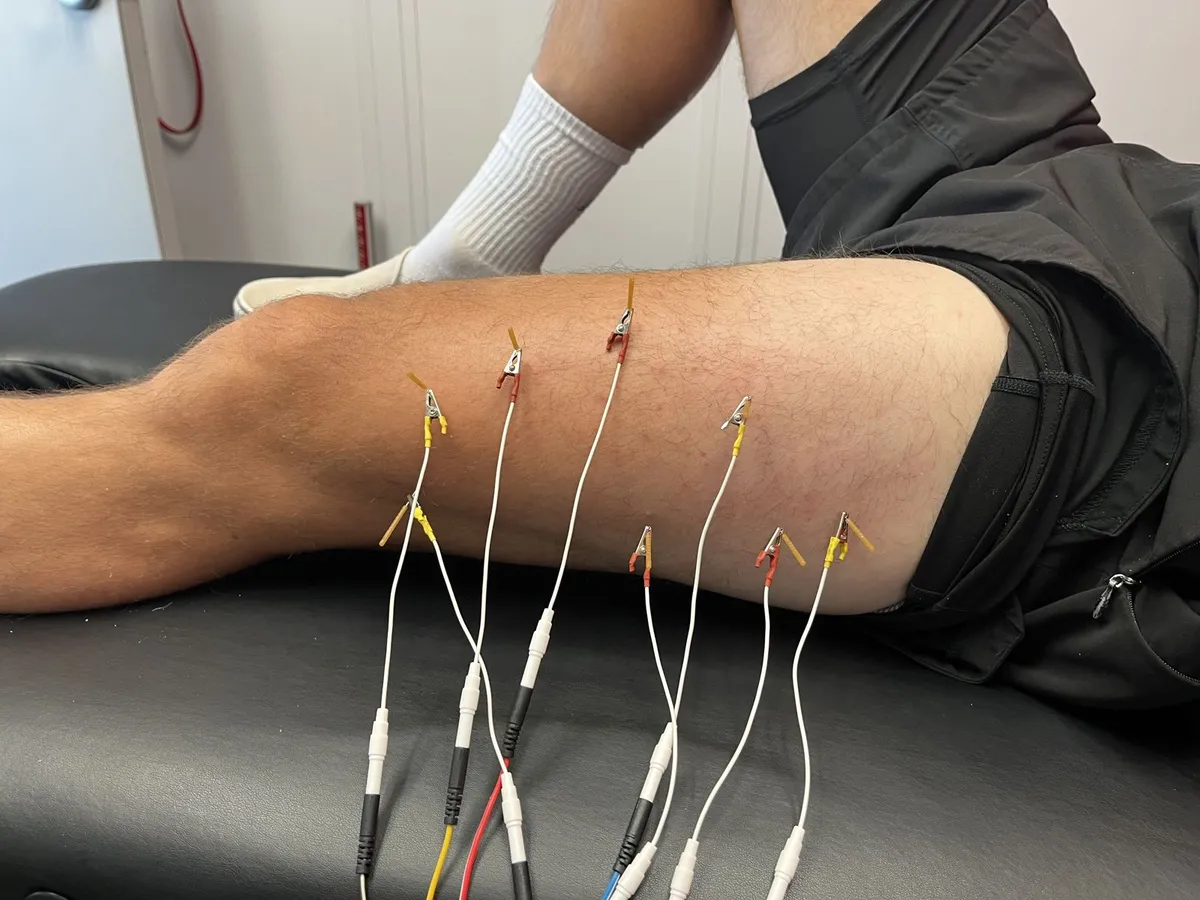 Dry needling with electrical stimulation on the thigh