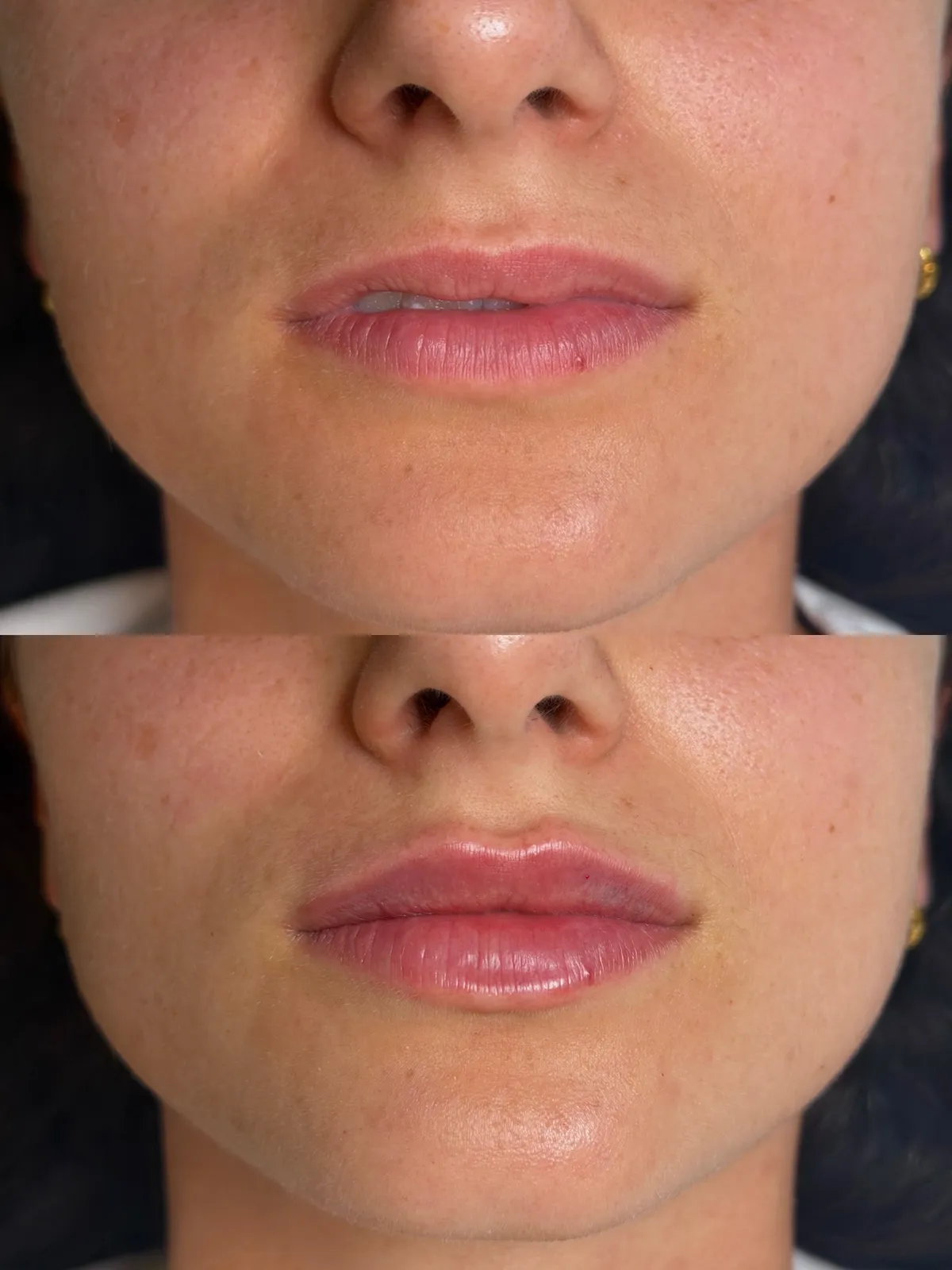 Before-and-after lip filler result at Clinique Le Rosewood