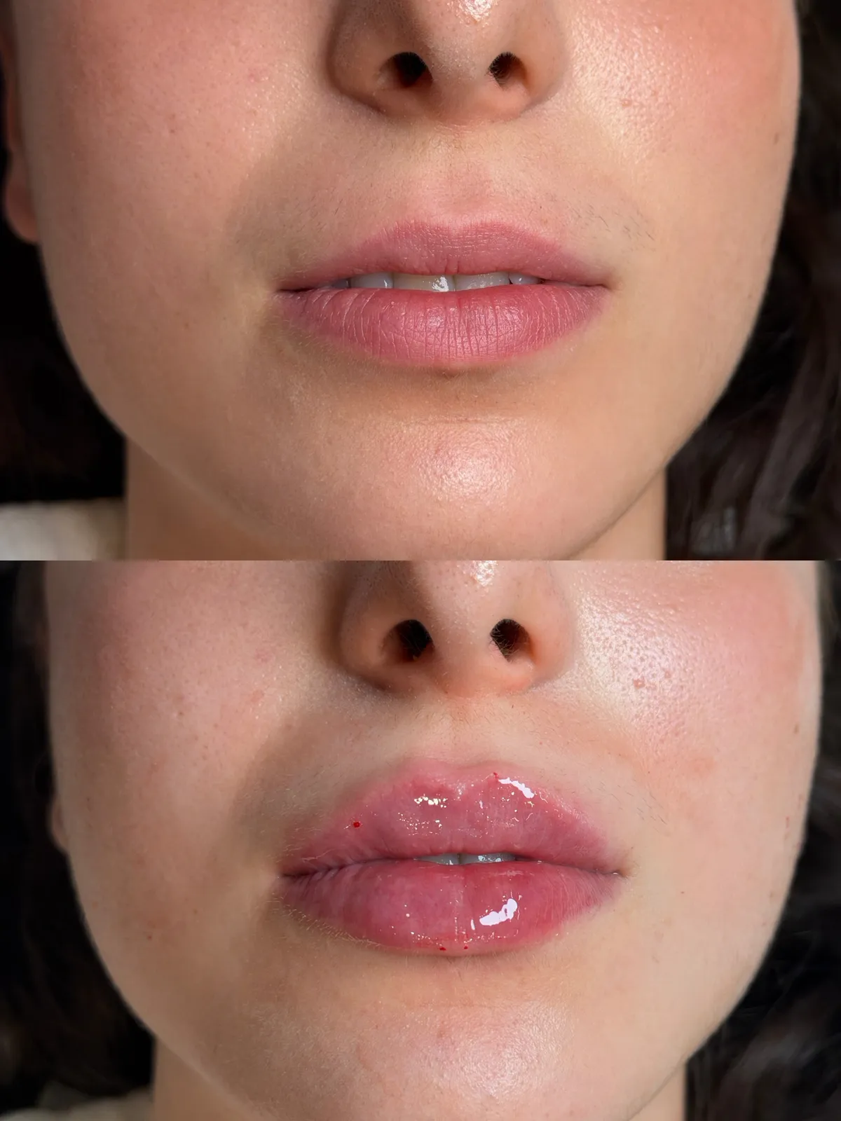 Before-and-after lip filler transformation at Clinique Le Rosewood