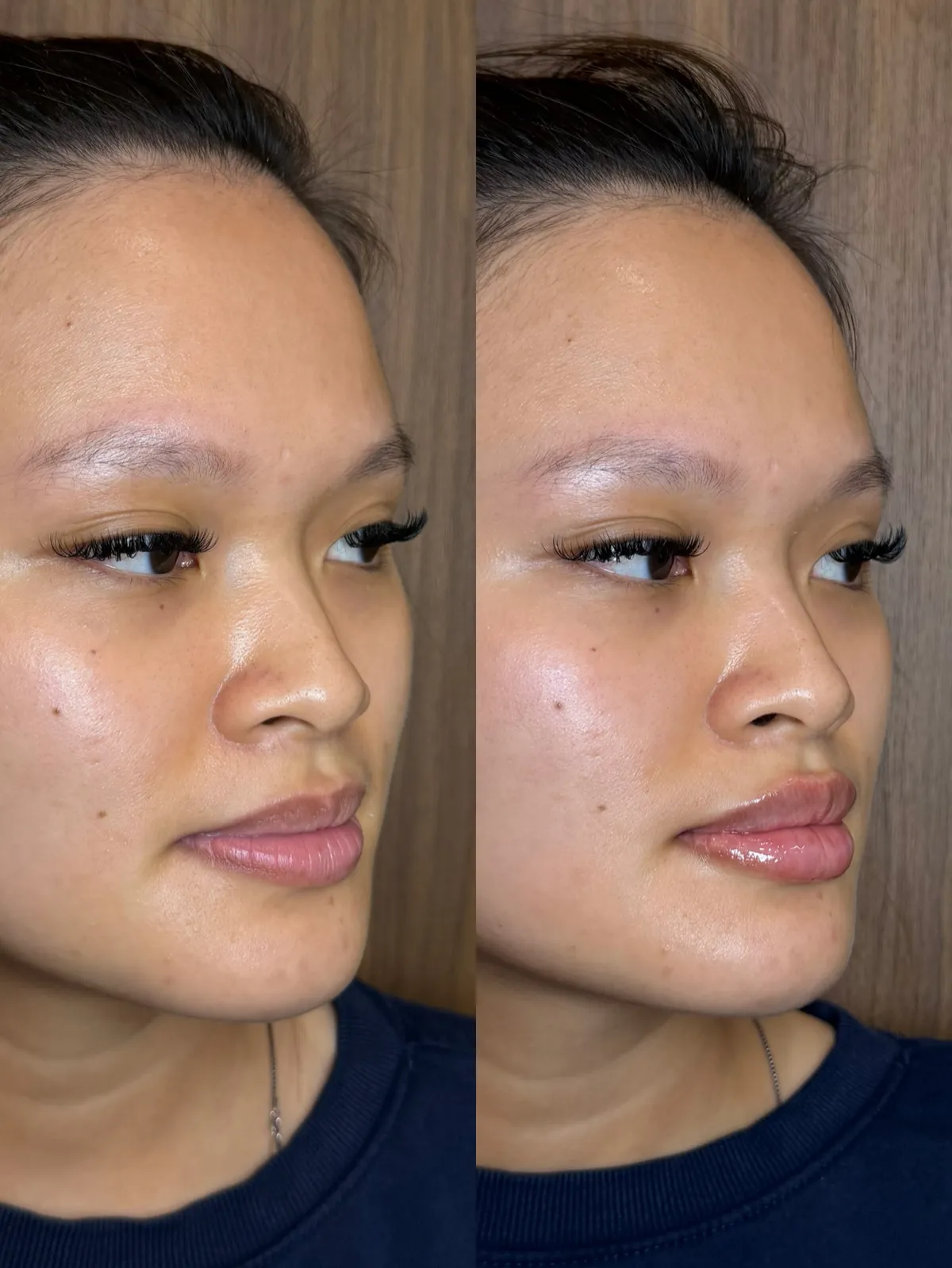 Le Rosewood lip enhancement before and after