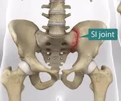 How Performance Based Physical Therapists are treating SI Joint Pain in Hurricane, WV