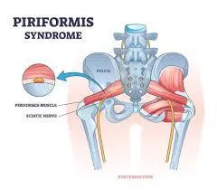 How Faith in Motion Performance Therapy treats Piriformis Syndrome and Sciatica 