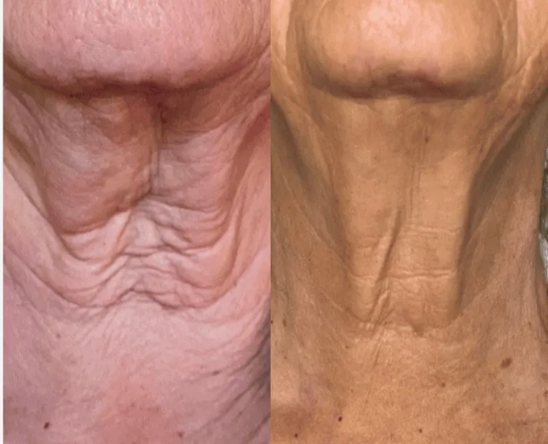 Skin Renewal Duo Neck Microneedling