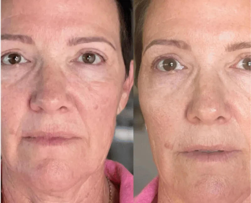 Skin Renewal Duo Face Microneedling