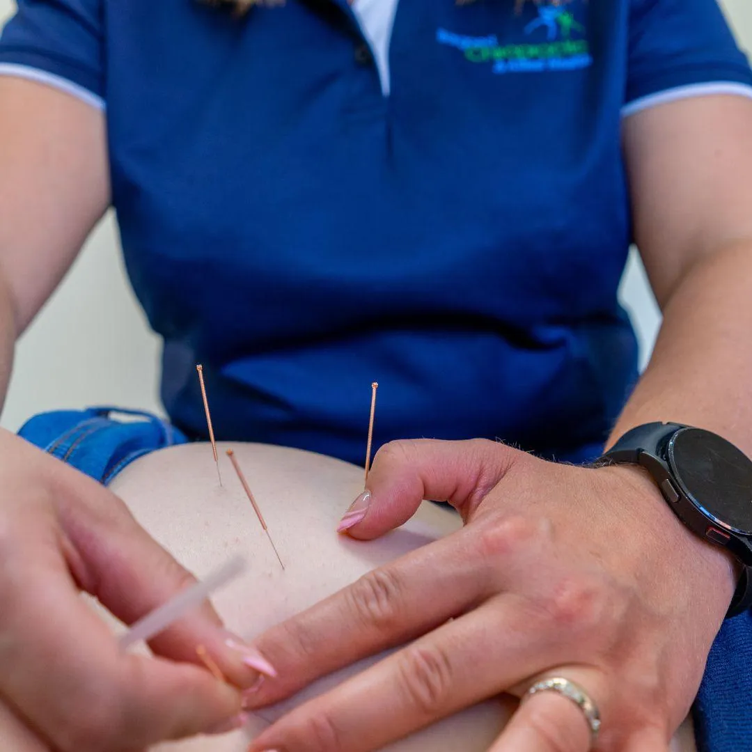 Chiropractor performing acupuncture treatment for back pain at Bargoed Chiropractic Clinic.