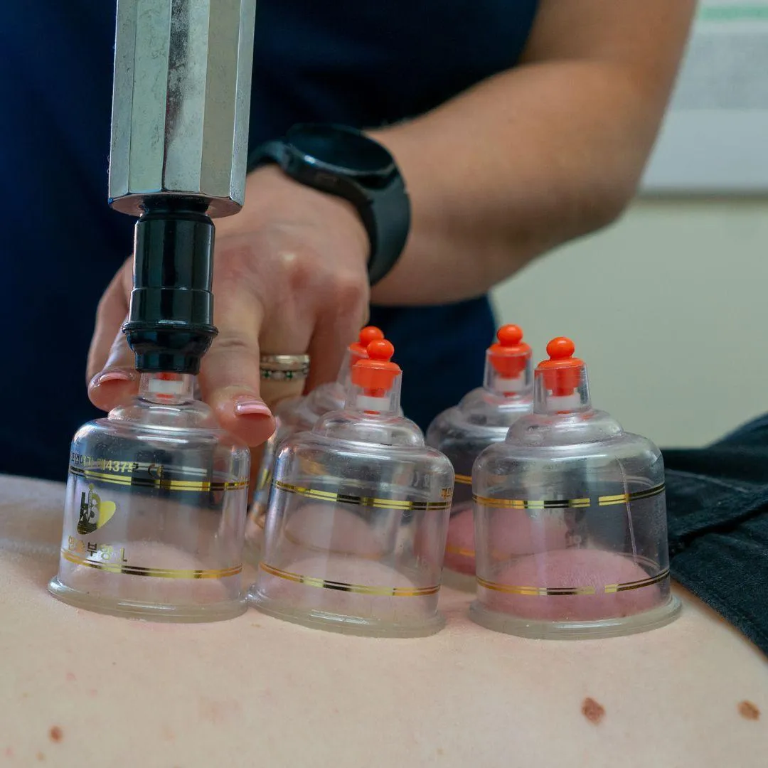 cupping therapy, chiropractic, pain relief, CF81, bargoed, back pain, neck pain, massage, cupping,