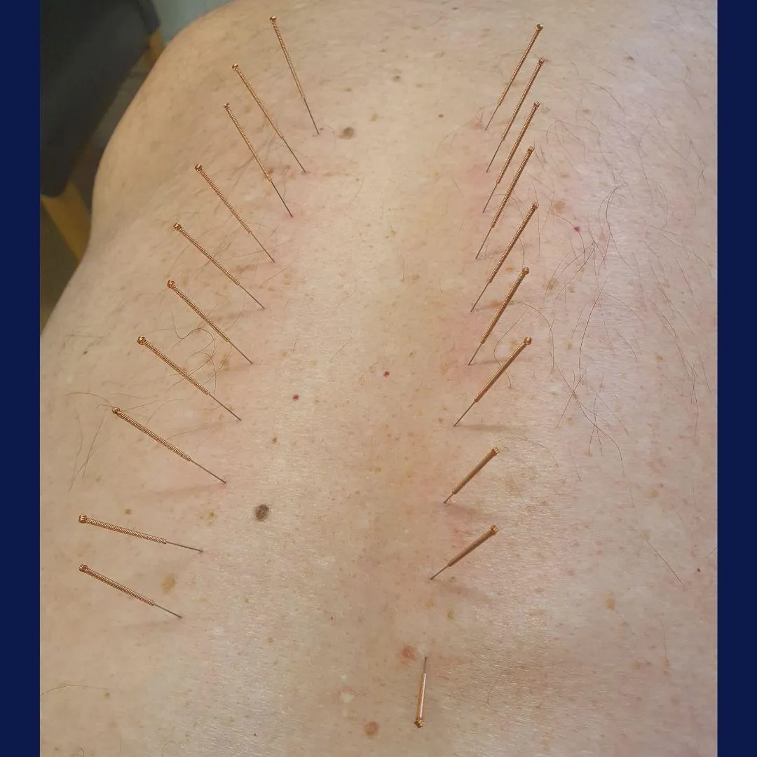 Dry needling treatment at chiropractic clinic in Bargoed CF81.
