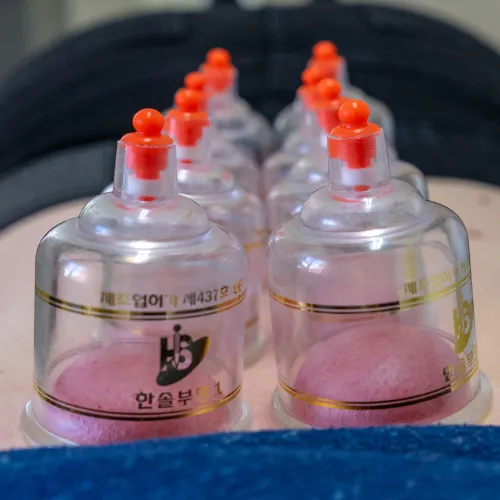 cupping therapy, chiropractic, pain relief, CF81, bargoed, back pain, neck pain, massage, cupping,