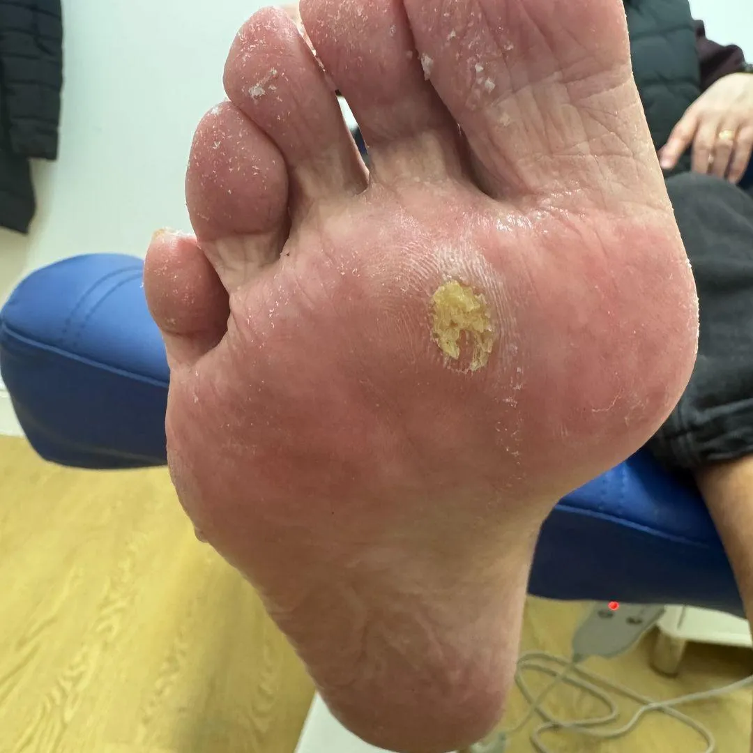 podiatry, podiatrist, foot care, foot pain treatment, ingrown toenail treatment, custom orthotics, nail surgery, foot clinic, diabetic foot care, foot health, podiatry services, podiatrist near me, podiatry Bargoed, podiatrist CF81, podiatry Blackwood, podiatry Caerphilly, foot assessment, minor nail surgery, foot specialist, heel pain treatment, plantar fasciitis treatment, toenail problems, 