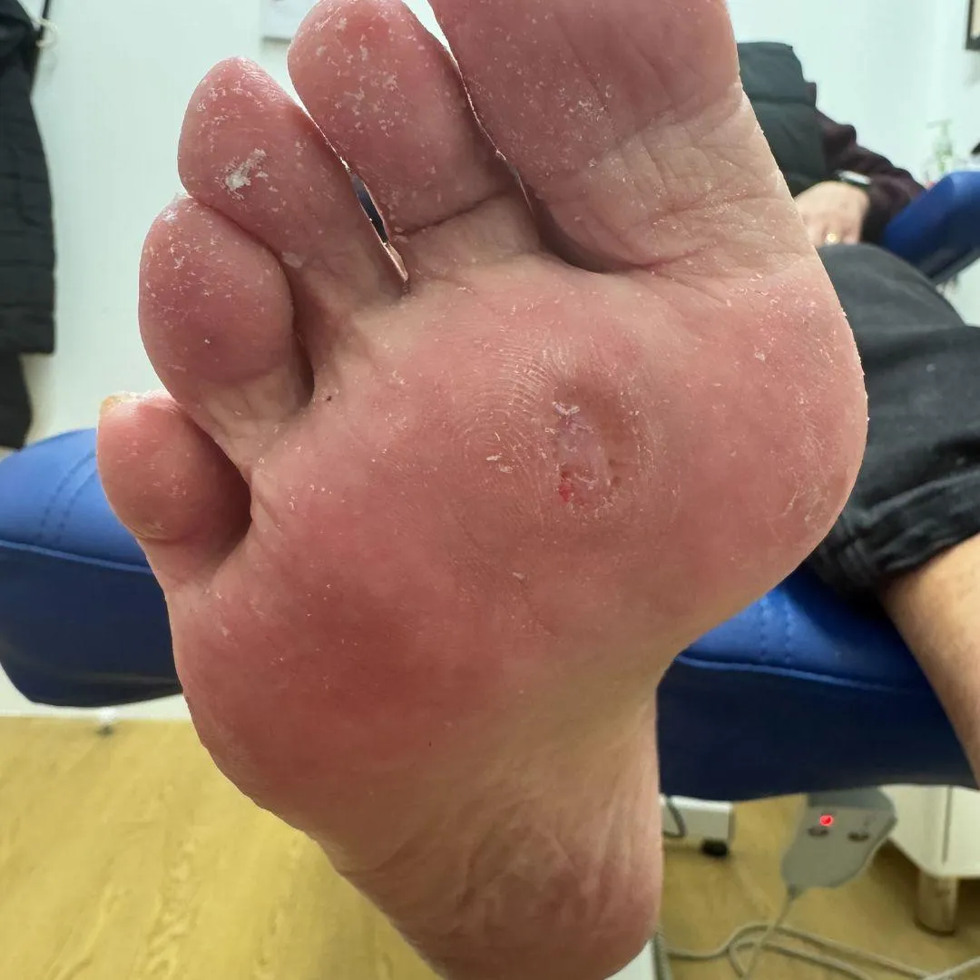 podiatry, podiatrist, foot care, foot pain treatment, ingrown toenail treatment, custom orthotics, nail surgery, foot clinic, diabetic foot care, foot health, podiatry services, podiatrist near me, podiatry Bargoed, podiatrist CF81, podiatry Blackwood, podiatry Caerphilly, foot assessment, minor nail surgery, foot specialist, heel pain treatment, plantar fasciitis treatment, toenail problems,