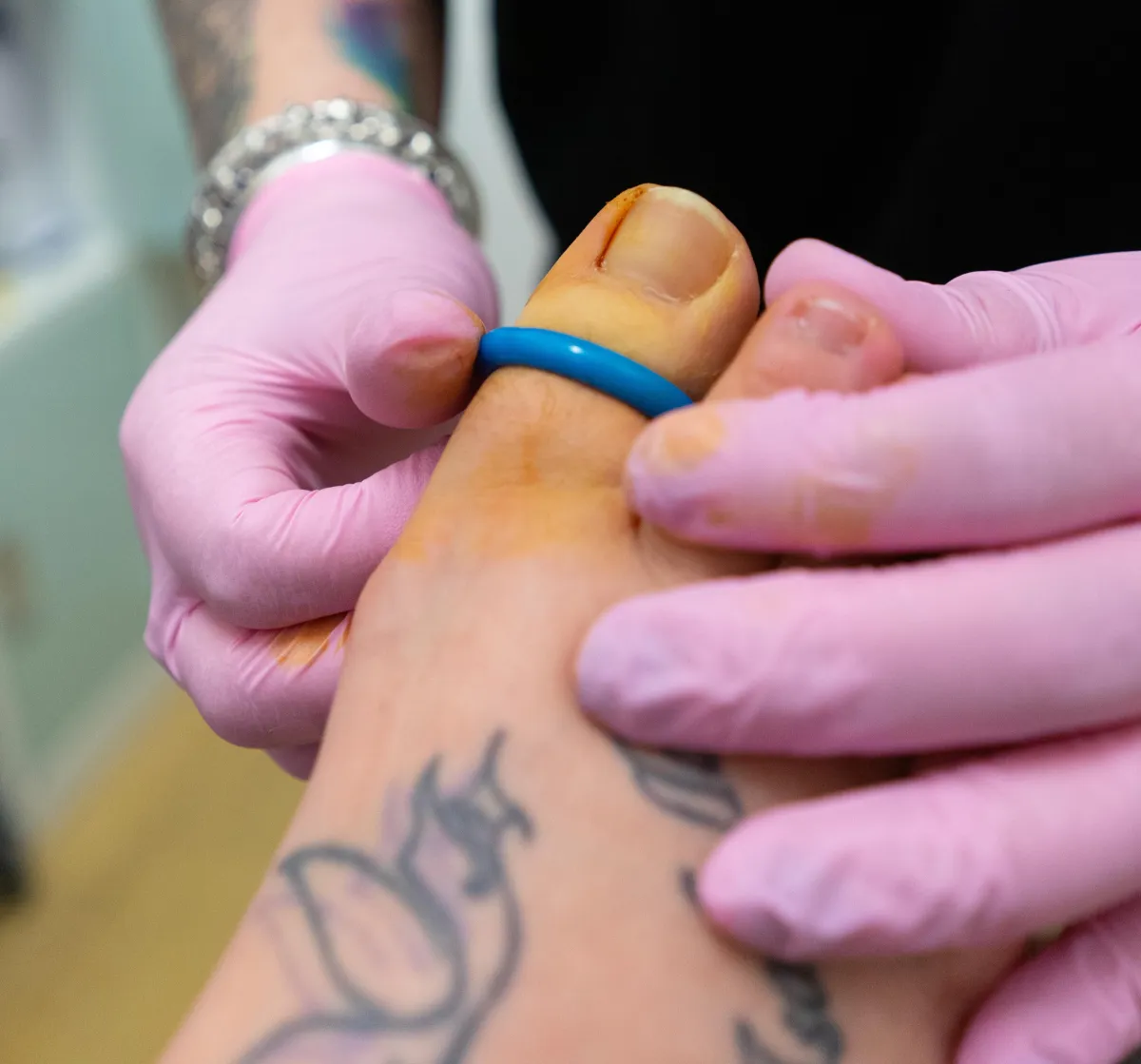 Podiatrist preparing toe for ingrowing toenail surgery, CF81, Bargoed, near Ystrad Mynach