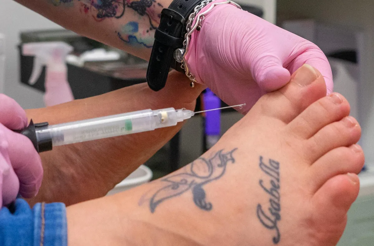 Podiatrist performing ingrown toenail treatment in Bargoed CF1, near Caerphilly