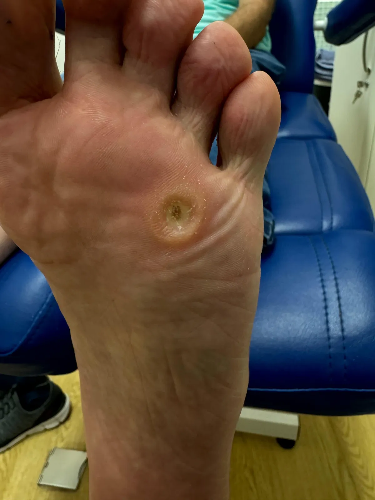 sole of foot showing corn removed after treatment