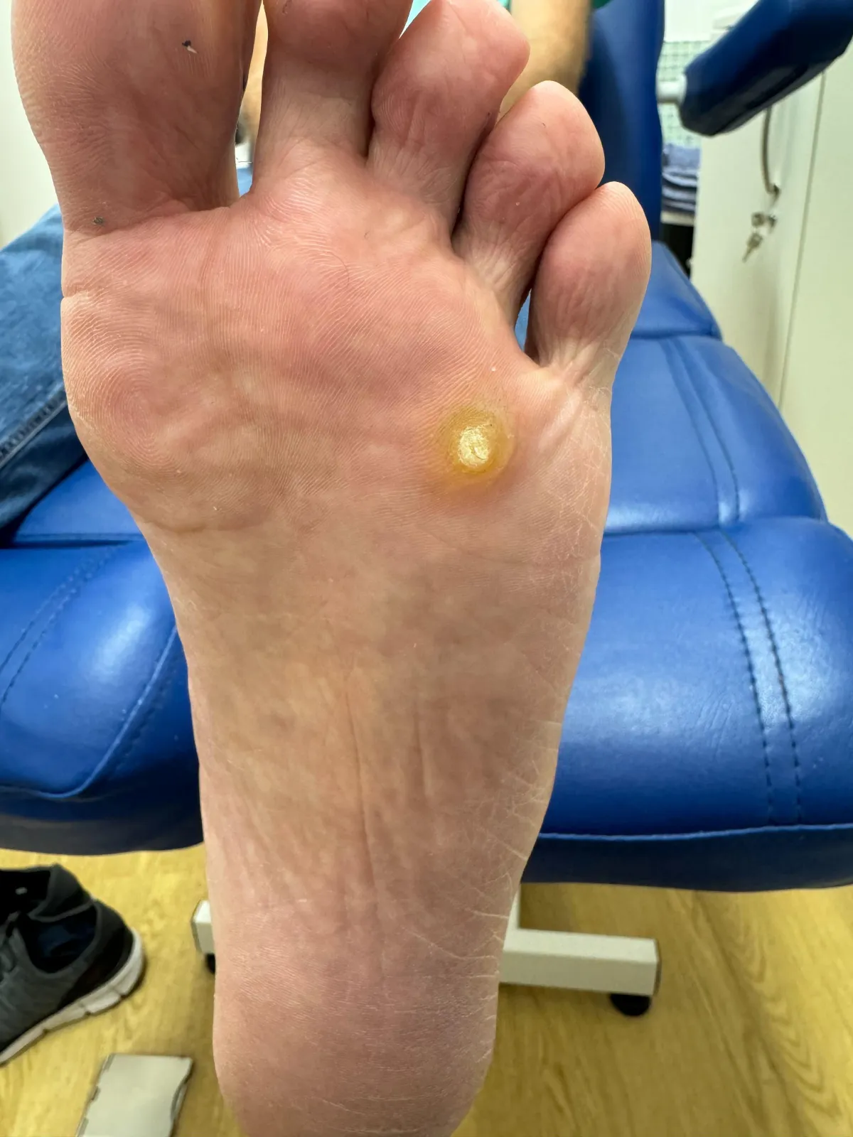 Sole of foot showing corn before treatment