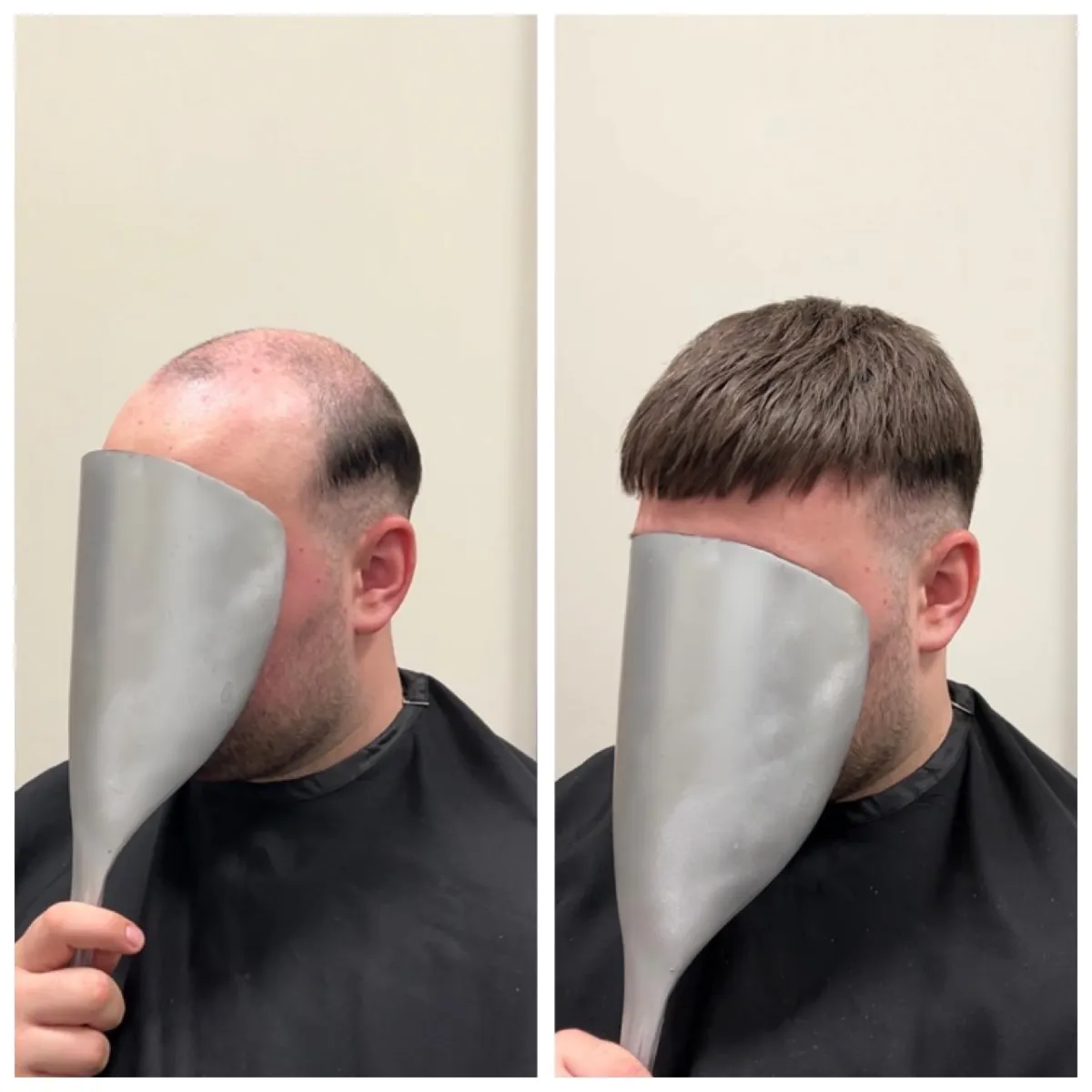 before ad after shots of a man with hailoss and him after he ha had a non surgical hair system